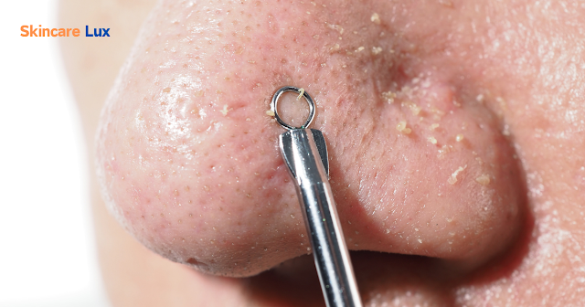 How can I remove my blackheads?
