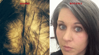 Women’s Hair Loss