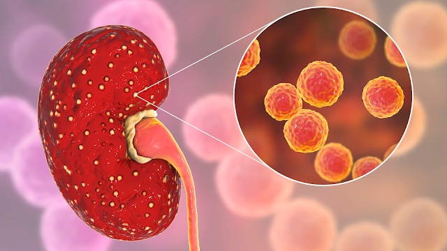 Bladder Cancer Treatment in Delhi