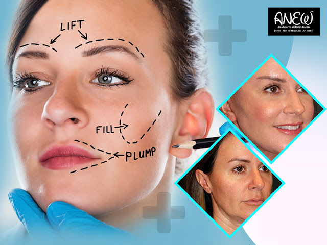 Face Lift Surgery in Bangalore