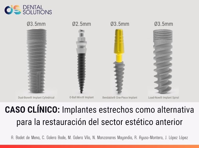 CASO CLÍNICO: Implantes estrechos como alternativa para la restauración del sector estético anterior