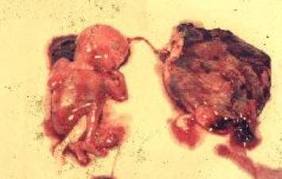  ABORSI  Gambar  Aborsi 