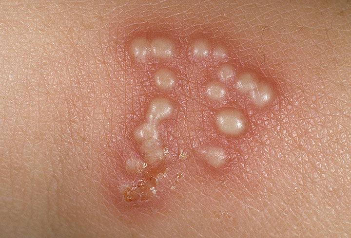 pengobatan herpes alami