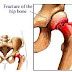 OSTEOPOROSIS