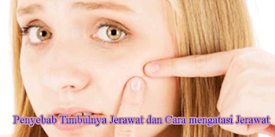 Penyebab Timbulnya Jerawat