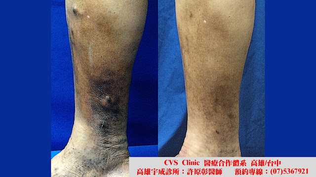 靜脈膠, 萬能膠, 黏膠閉合手術, 過敏反應, 類靜脈炎反應, 靜脈膠閉合手術, 微創靜脈勾除手術, 局部麻醉, 靜脈曲張, 蚯蚓狀, 網狀, 蜘蛛絲狀, 微創雷射手術, 硬化劑注射治療, 表皮雷射, 血栓靜脈炎, 色素沉澱, 腳痠脹, 腳疼痛, 血管超音波, varicose vein, EVLA, endovenous laser ablation, sclerotherapy, thrombophlebitis, reticular vein, spider vein, pigmentation, transcutaneous laser, Ambulatory phlebectomy, venaseal, vein glue, phlebitis, phlebitis-like abnormal reaction, PLAR, hypersensitivity 靜脈膠, 萬能膠, 黏膠閉合手術, 過敏反應, 類靜脈炎反應, 靜脈膠閉合手術, 微創靜脈勾除手術, 局部麻醉, 靜脈曲張, 蚯蚓狀, 網狀, 蜘蛛絲狀, 微創雷射手術, 硬化劑注射治療, 表皮雷射, 血栓靜脈炎, 色素沉澱, 腳痠脹, 腳疼痛, 血管超音波, varicose vein, EVLA, endovenous laser ablation, sclerotherapy, thrombophlebitis, reticular vein, spider vein, pigmentation, transcutaneous laser, Ambulatory phlebectomy, venaseal, vein glue, phlebitis, phlebitis-like abnormal reaction, PLAR, hypersensitivity