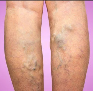 who is affected to varicose veins and spider veins?_ichhori.webP