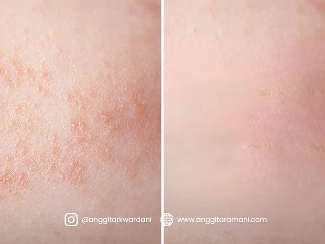 Dermatitis atopik pada anak