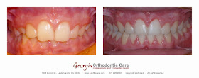 Deep Bite, Overbite, Orthodontic Treatment, Lawrenceville, GA 30043