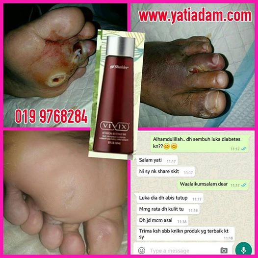 ulser kaki, luka kencing manis, rawatan ulser kaki, foot ulcer, foot ulcer infection, foot ulcer types, jangkitan ulser kaki, jenis ulser kaki