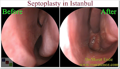 Septoplasty in Istanbul - The Nasal Septum - Deviated Septum - Septoplasty Definition - Symptoms of Deviated Septum - Septoplasty Price Istanbul - Septoplasty in Turkey - How Much Does Deviated Septum Repair? - Caudal Septoplasty - Septoplasty in Turkey - Septoplasty Turkey - Cost of Septoplasty - Symptoms of Nasal Septum Deviation - Septoplasty Operation - Diagnosis of Deviated Nasal Septum - Diagnosis of Deviated Septum - Differential Diagnosis of Deviated Nasal Septum - Nasal septal deviation - NSD - Types of deviated septum - Normal nasal septum - "C"- shaped deviation of the septum - "S"- shaped deviation of the septum - Dislocation of septal cartilage - Subluxation of septal cartilage - Dislocation of the caudal septum - Caudal septum deviation - Septal spur - Thickening of the nasal septum - Septum deviasyonu türleri - Nasal septal spur - Bone spur formation of the septum - Anterior dislocation of septum - Caudal dislocation of septum - How Much Does a Septoplasty Cost in Istanbul? - Septoplasty Operation Technique - Surgcal Technique of Septoplasty Operation - Nasal Splint Removal Video - Silicone Nasal Splints Advantages - Post-Operative Instruction For Septoplasty - Risks And Complications Of Septoplasty - Risks And Complications Of Deviated Septum Surgery - Nasal Septal Perforation - Nasal Septum Perforation - Nasal Septum Perforation Symptoms - Nasal Septum Perforation Diagnosis - Nasal Septum Perforation Treatment - Nasal Septum Perforation Closure - Nasal Surgical Repair Of Nasal Septum Perforation - Nasal Adhesion (Synechia) - Nasal Tip Ptosis - Saddle Nose Deformity - Saddle Nose Correction - Positive Health Effects Of Deviated Nasal Septum Surgery - Positive Health Effects Of Septoplasty Surgery - Functions of The Nose - Contact Point Headaches