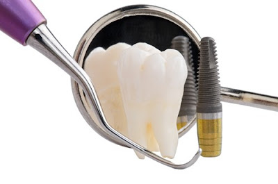 Dịch vụ trồng răng Implant thẫm mỹ