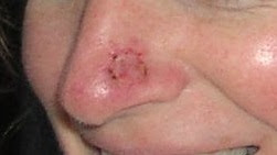 skin cancer on nose