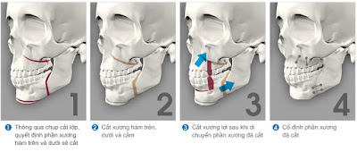 Phẫu thuật hàm hô móm là gì?