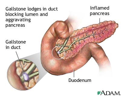 ||Can gallbladder problems