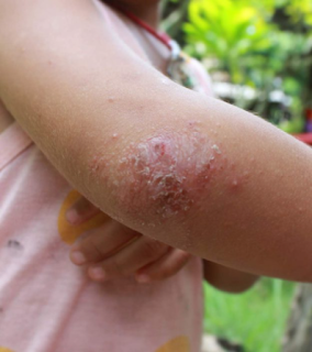 Psoriasis treatments, diagnosis and symptoms in children and adolescents