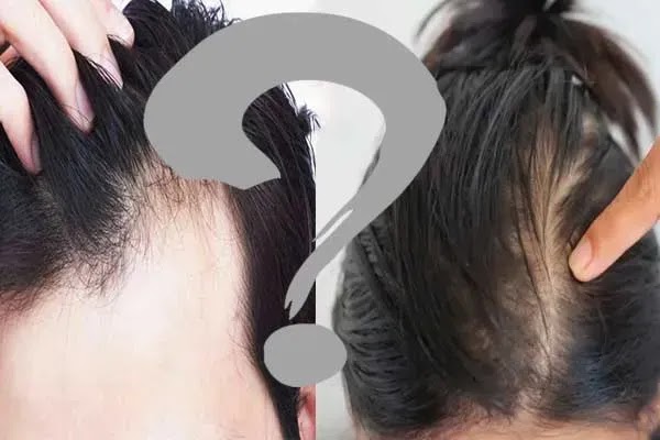 كل ما تحتاج ان تعرفه عن تساقط الشعر للرجال و النساء