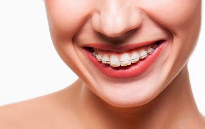 Niềng răng mắc cài sứ dây trong là phương pháp gì? 1