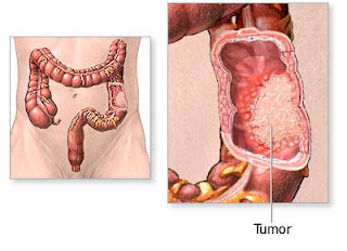 Rectal Cancer - Colon Cancer