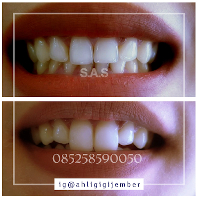 Veneer gigi kota pati bumi mina tani bunny smile merapikan gigi dengan veneer