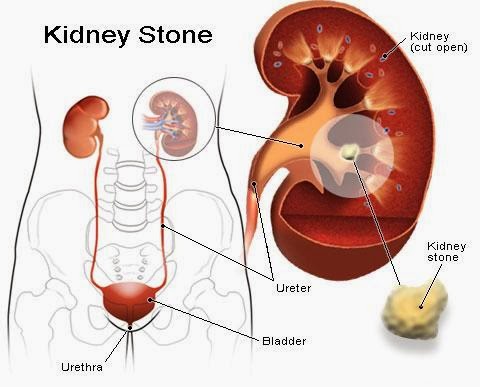  Renal Calculus – Urolithiasis – Kidney Stones Homeopathy Specialty Treatment Hospital in Velachery, Chennai, Tamilnadu, India 