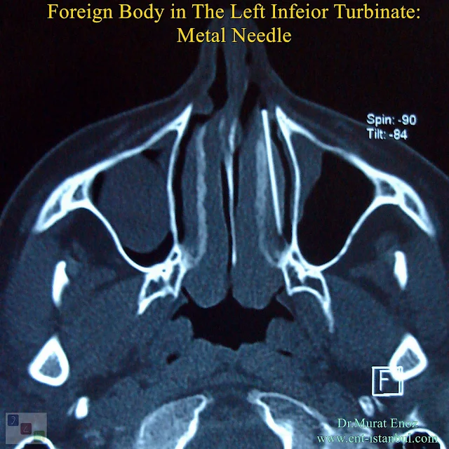 Metal Needle,Foreign Body in The Left Infeior Turbinate,