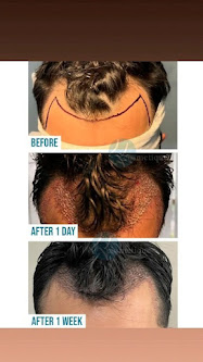 best hair transplant in lahore, before and after