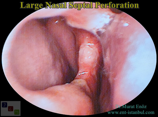 nasal septal hole closure,repairing of  septum perforation, septum perforation surgery in istanbul