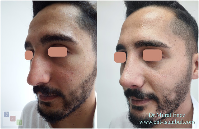 Male rhinoplasty, Nose job for men, Natural nose aesthetic for men
