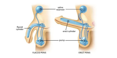 Flaccid or erect penis