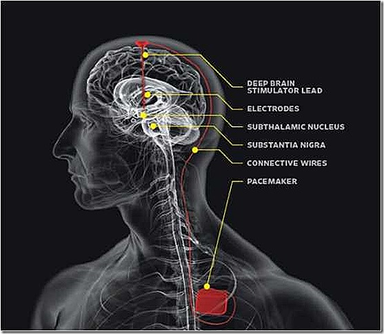 Brain-Pacemaker