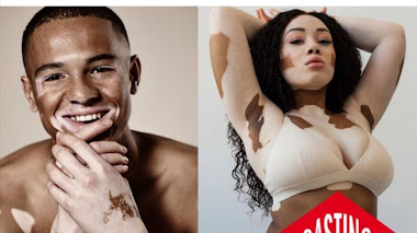 ARGENTINA: Se buscan HOMBRES y MUJERES con VITILIGO para COMERCIAL