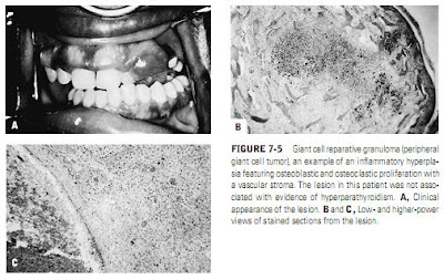 Giant Cell Granuloma (Peripheral and Central)