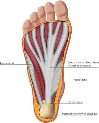 plantar fasciitis