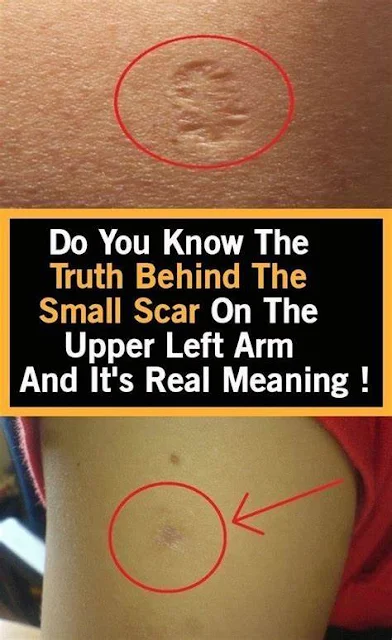 This Is The Truth Behind The Scar Everyone Has On The Upper Left Arm