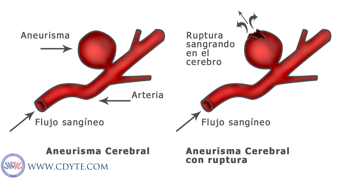 Aneurisma Cerebral: causas, sintomas e tratamentos