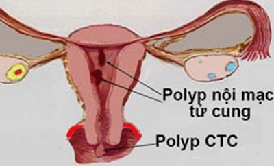 Dấu hiệu polyp cổ tử cung