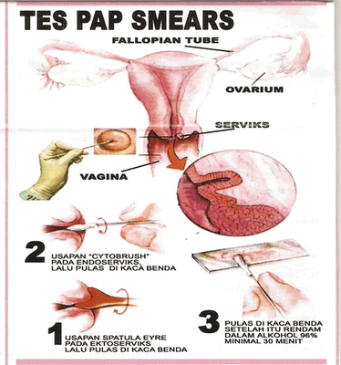 Image result for gambar tes pap smear