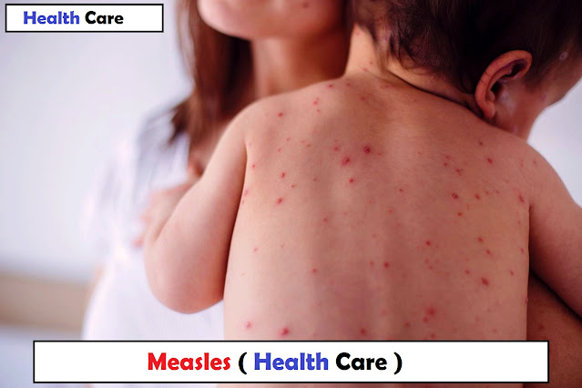 Measles Symptoms – Cause – Treatment – Health Care