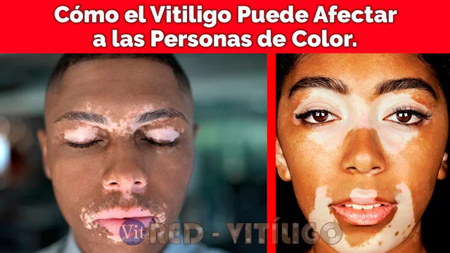 Cómo el Vitiligo Puede Afectar a las Personas de Color.