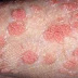 Genital Warts Symptoms