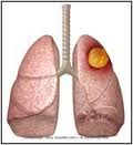 lung-abscess-image