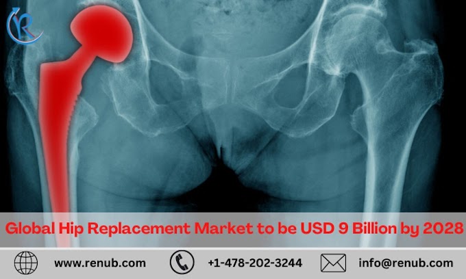 Hip Replacement Market, Global Forecast 2023-2028, Industry Trends, Growth, Impact of Inflation, Opportunity Company Analysis