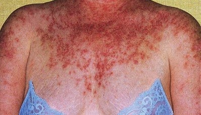 Penyakit Obat Lupus Penyakit Obat Lupus