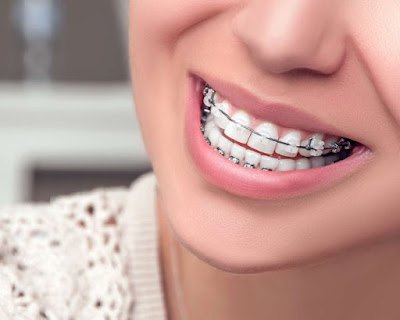 Dấu hiệu nhận biết niềng răng xong bị hở lợi 2