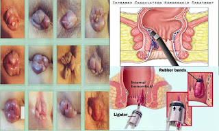 obat ambeien ampuh alami di apotik k24