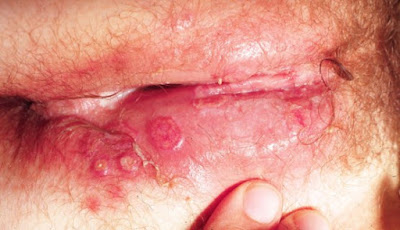 Herpes Pada Kelamin Wanita