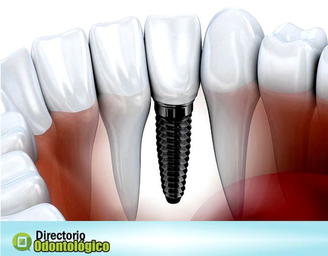 dental implant