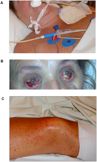 Febre hemorrágica de Lujo (LUHF) - vírus da família Arenaviridae - quadro clínico e tratamento