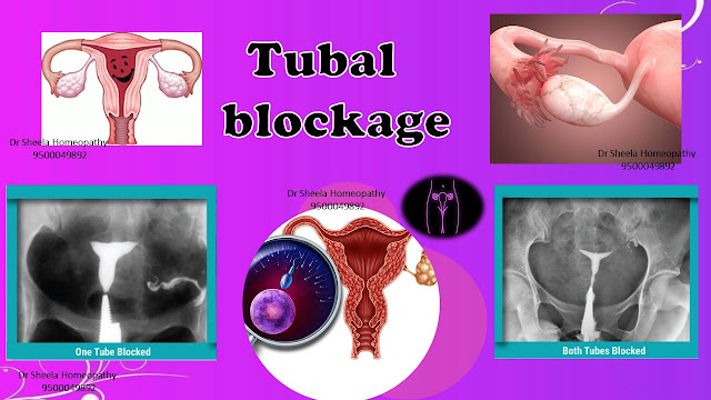 Bilateral Tubal Block Homeopathic Treatment in Chennai